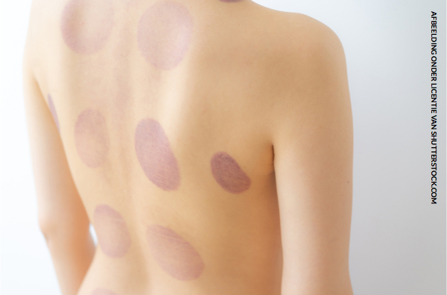 Fascia cupping Drachten